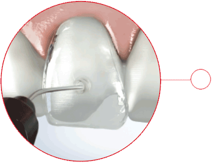 veneernow_callouts-web_03 VeneerNow - Injection stalk for flowable composite